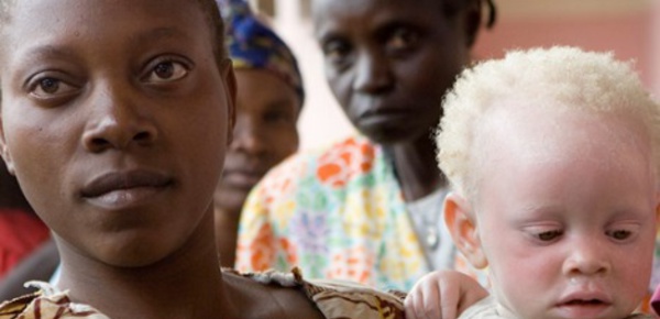 La chasse aux albinos